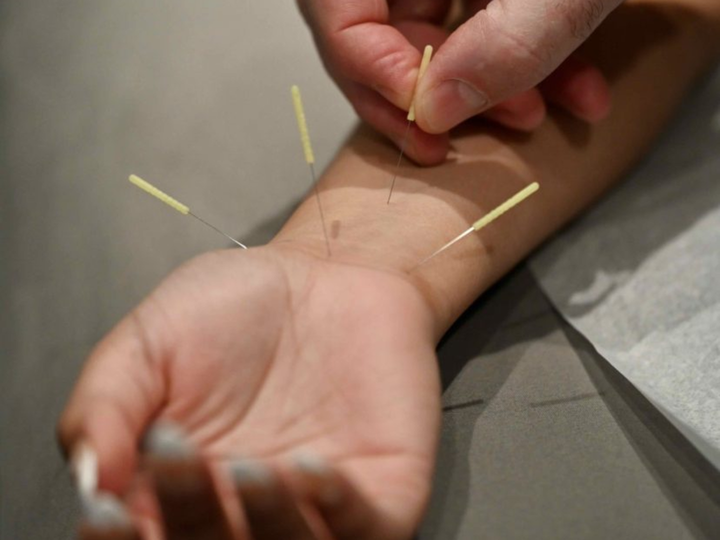 Acupuncture needles placed on the wrist during treatment at SageMED in Bellevue