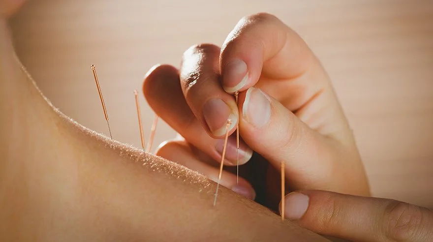 Acupuncture needles placed during a session at Chrystal Clinic