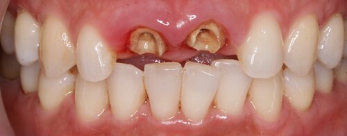 Anterior Crowns Before Image