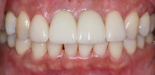 Anterior Crowns After Image