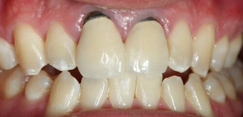 Anterior Crowns Before Image