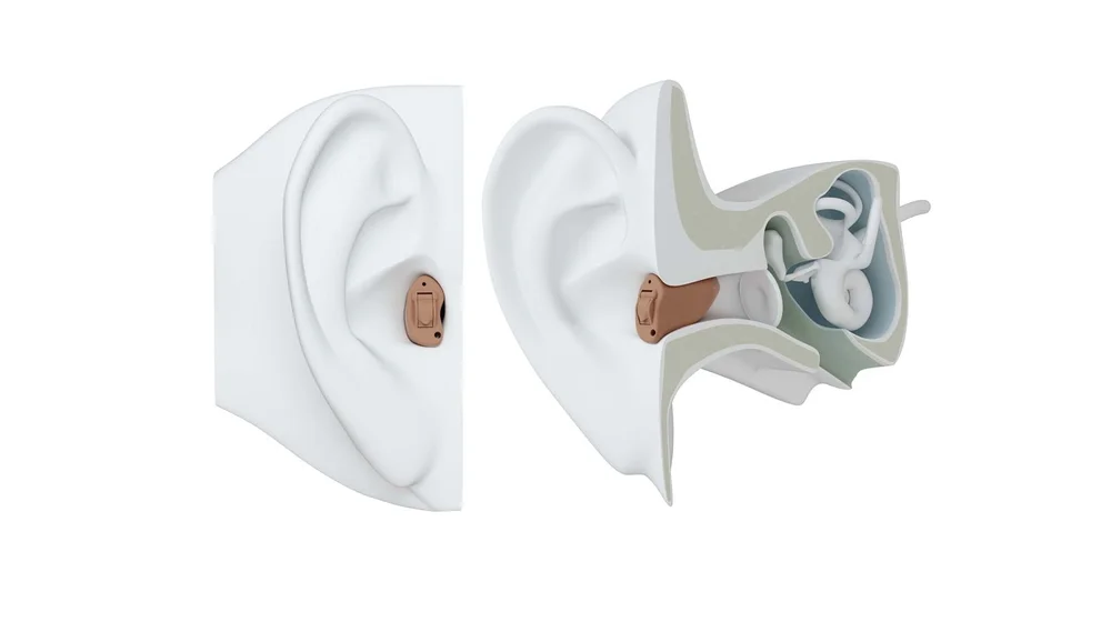 Illustration showing how a completely in the canal hearing aid sits on and inside the ear