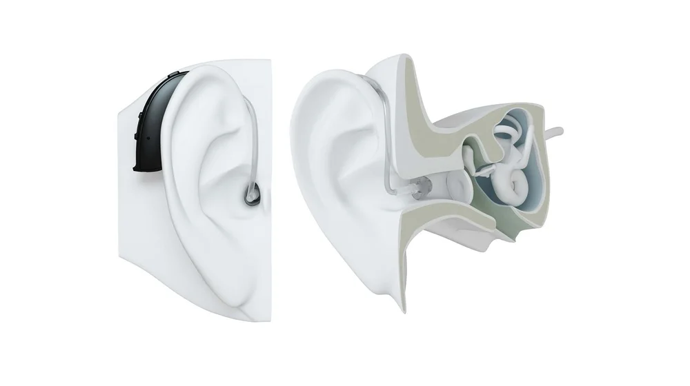 Illustration showing how a behind the ear hearing aid sits on and inside the ear