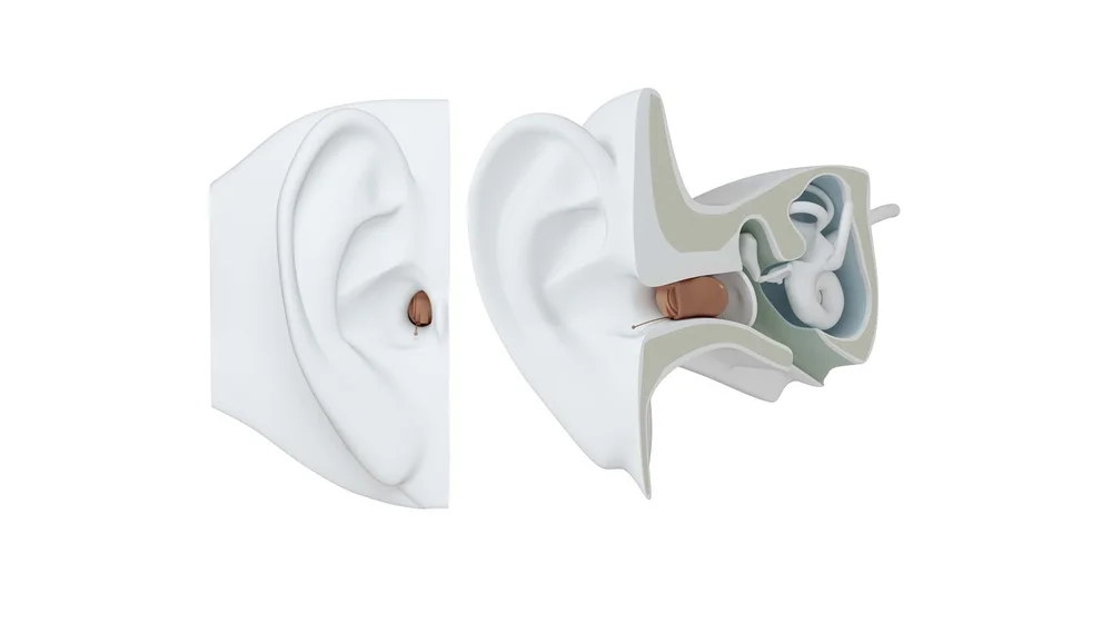 Illustration showing how an invisible in the canal hearing aid sits on and inside the ear