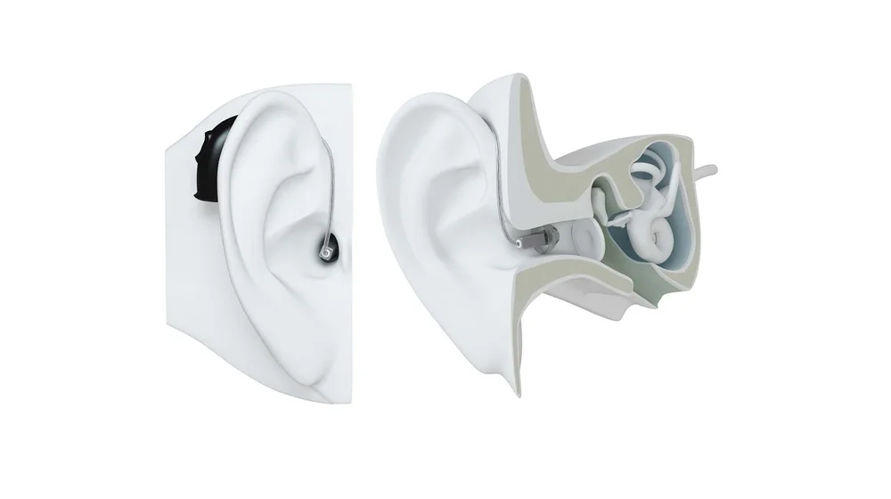 Illustration showing how a receiver in canal hearing aid sits on and inside the ear