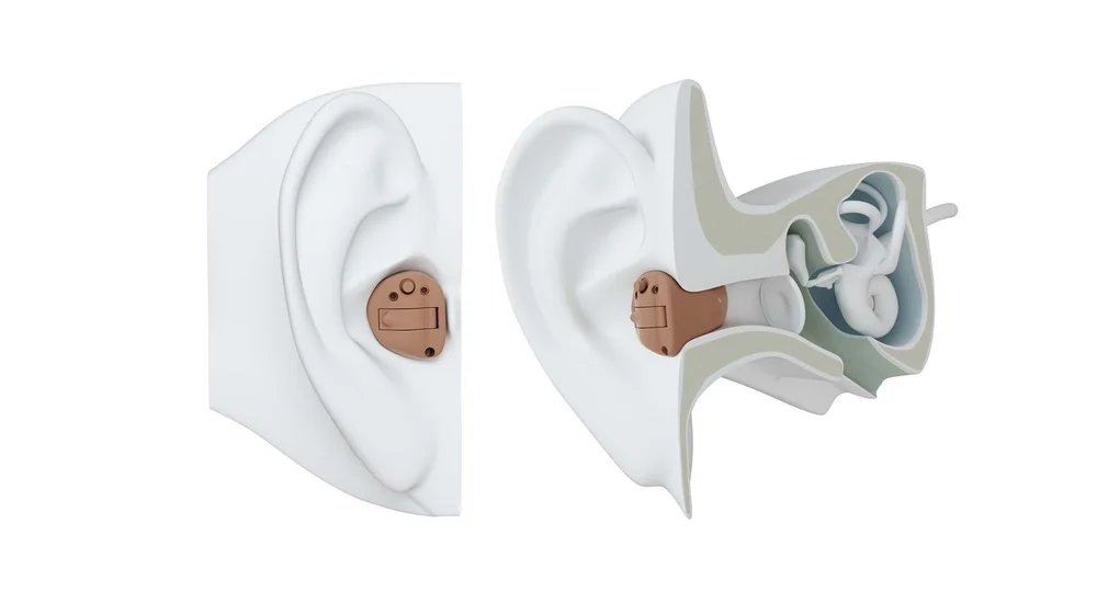 Illustration showing how an in the canal hearing aid sits on and inside the ear