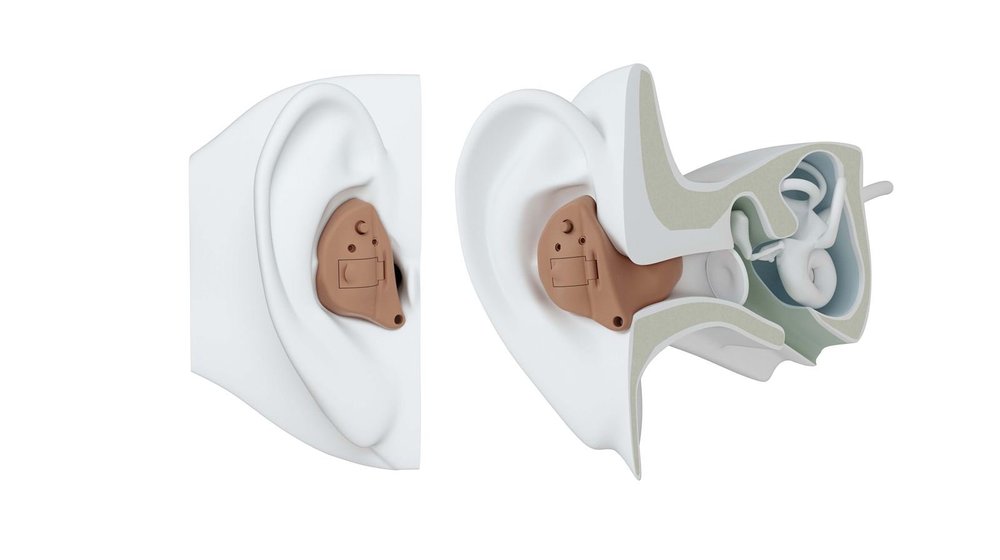 Illustration showing how an in the ear hearing aid sits on and inside the ear