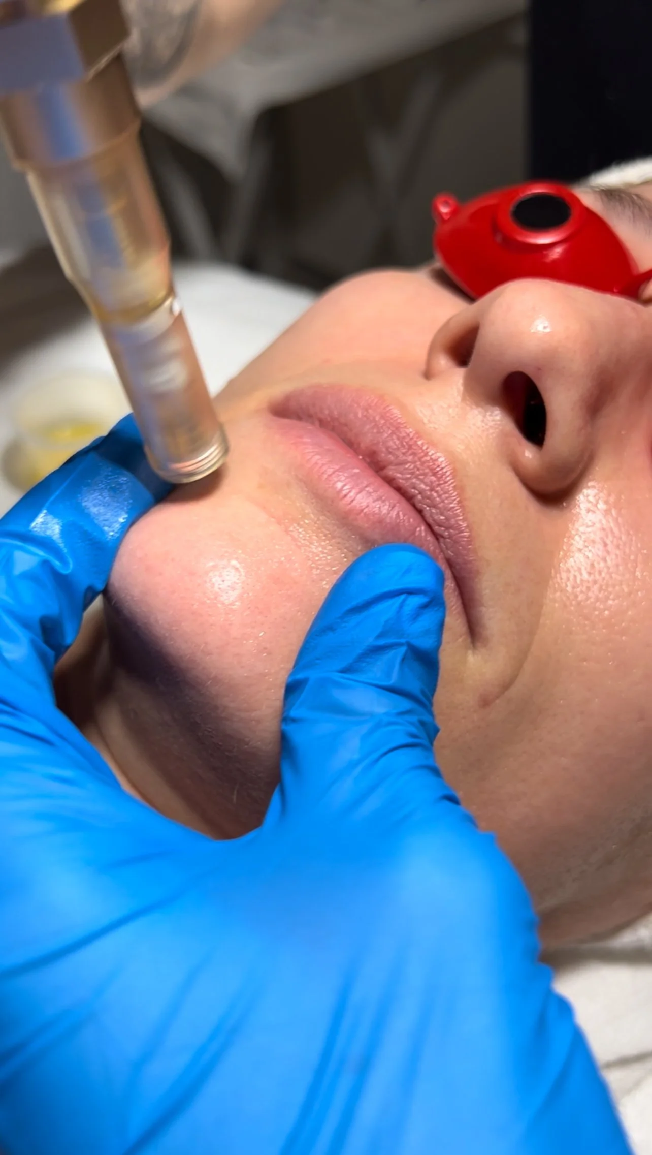 Microneedling Treatment Process