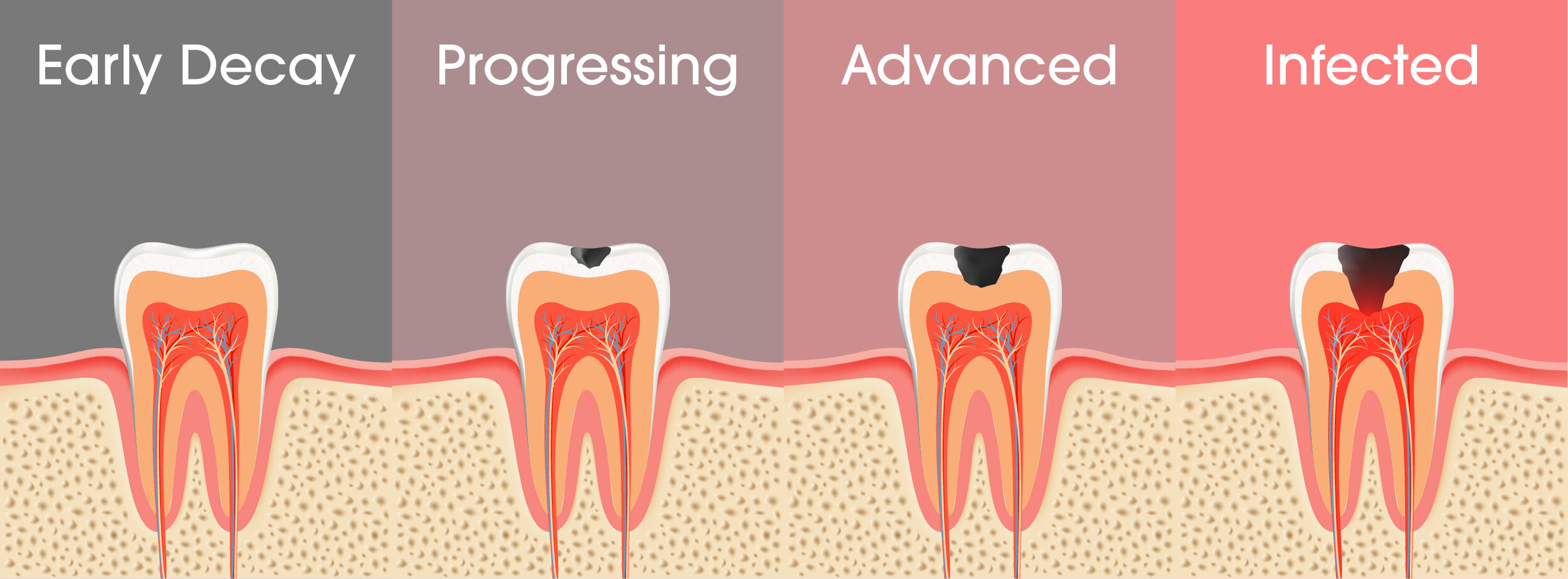 Tooth Decay Illustration