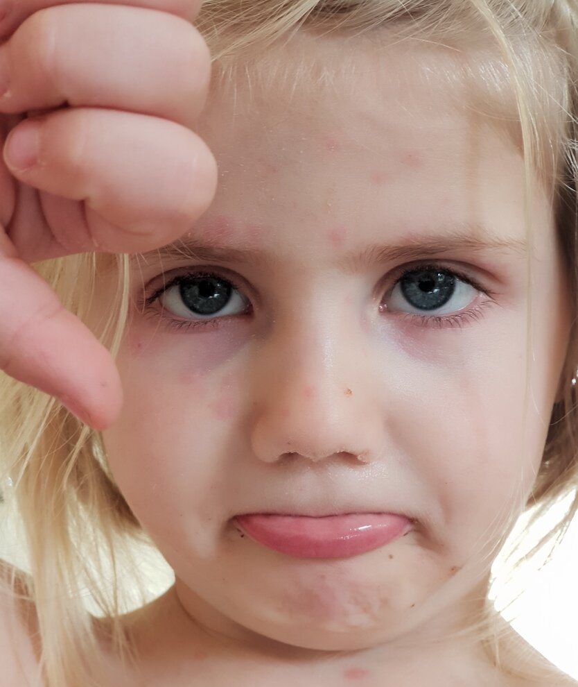 Baby Girl With Chickenpox High-Res Stock Photo - Getty Images