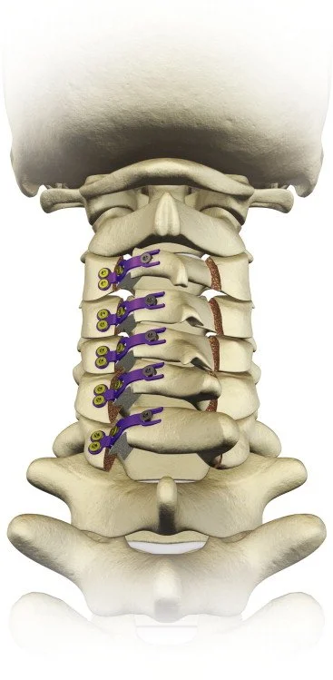 Colonne cervicale vue de l'arrière après une laminoplastie&nbsp;: d'un côté, de petites plaques violettes maintiennent ouverts les arcs vertébraux&nbsp;; de l'autre, une rainure sert de charnière&nbsp;; les apophyses épineuses sont toujours en place.