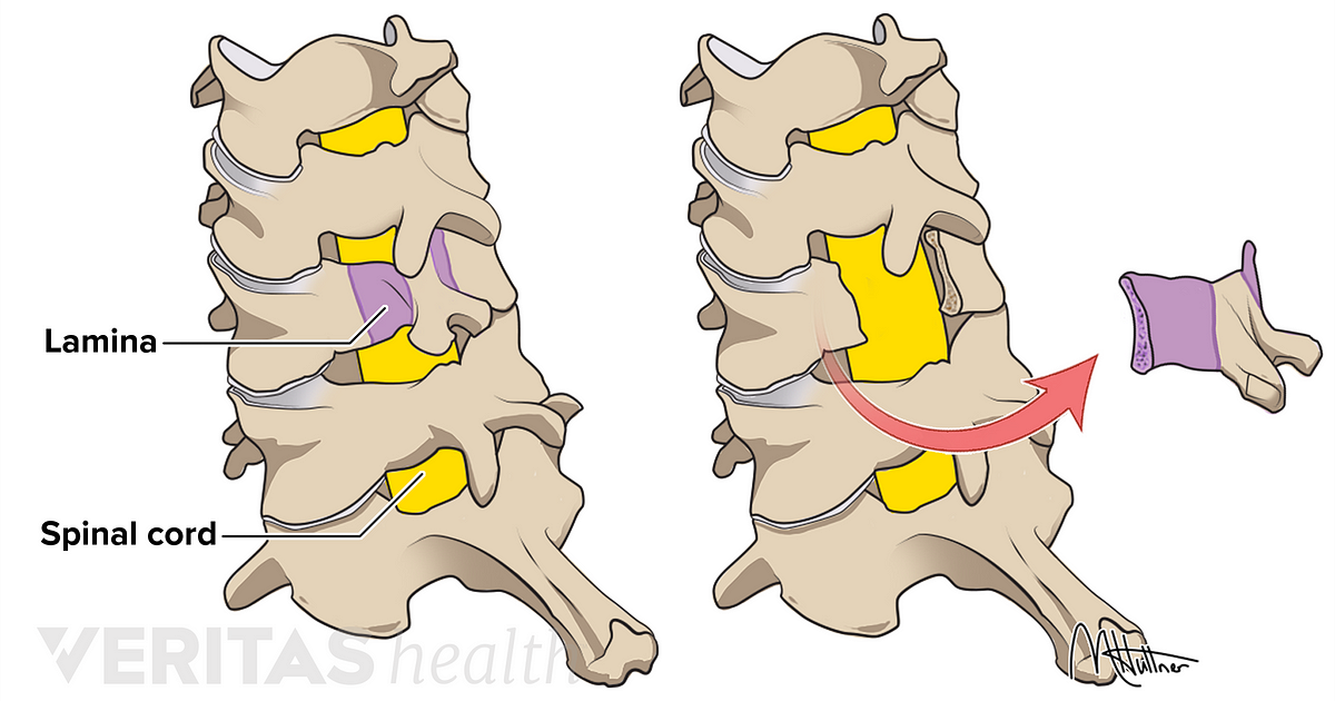 Deux dessins de vertèbres cervicales vues de l'arrière&nbsp;: à gauche avec l'arc vertébral (violet) au-dessus de la moelle épinière (jaune), à droite avec l'arc vertébral retiré.