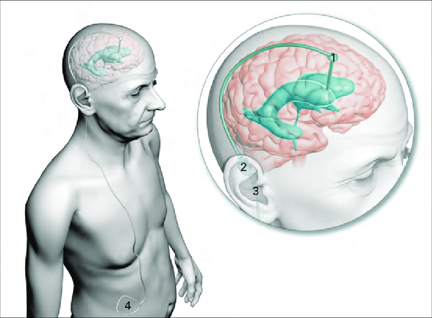 Older man with a shunt under the skin; an enlargement of the head shows the tube from the ventricle, the valve behind the ear and the route to the abdomen.