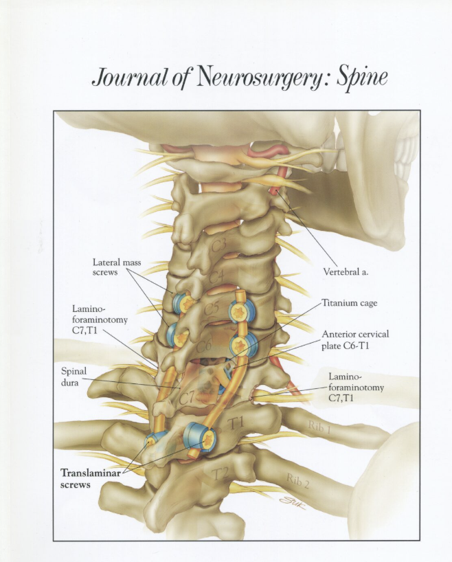 Drawing of the lower cervical and upper thoracic vertebrae with a cage and plate at the front as well as screws and rods at the back.