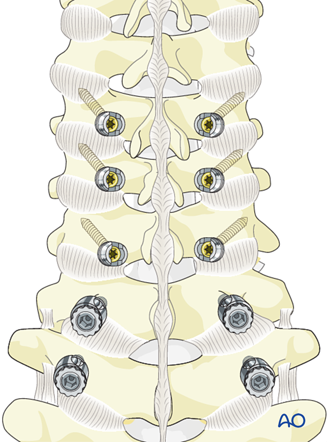 Back of the cervical spine with screws in the vertebrae on both sides of the midline, ready to be connected with rods.