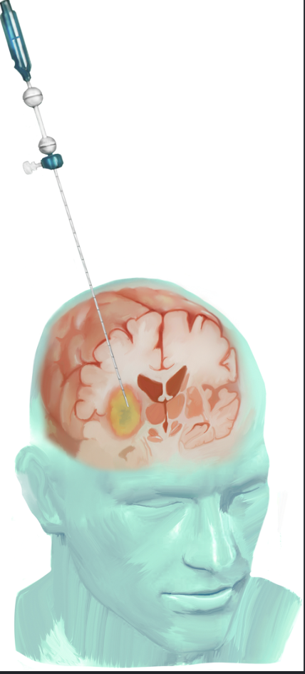 Dessin d'une fine aiguille de biopsie munie de deux billes réfléchissantes, introduite dans le cerveau par un petit trou dans le crâne.