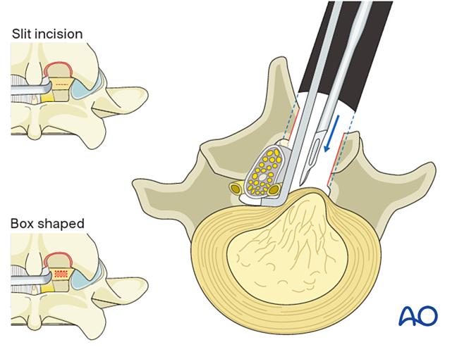 Cross-section of a lumbar vertebra seen from above: the dural sac is held aside and the fibrous ring of the intervertebral disc is opened with a small blade; two insets show a slit-shaped and a window-shaped opening.