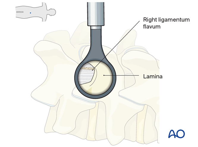 Vue à travers un tube étroit sur l'arc vertébral (lame) et le ligament jaune épaissi (ligamentum flavum).