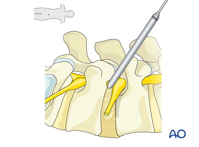 Side view of the lumbar spine: a thin instrument enters obliquely from the side through the nerve opening, just below the exiting yellow nerve root, as far as the intervertebral disc.