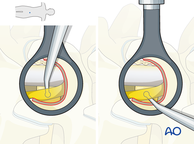 Two magnified views through a small opening between two vertebrae: the yellow nerve root is freed and checked with fine instruments.
