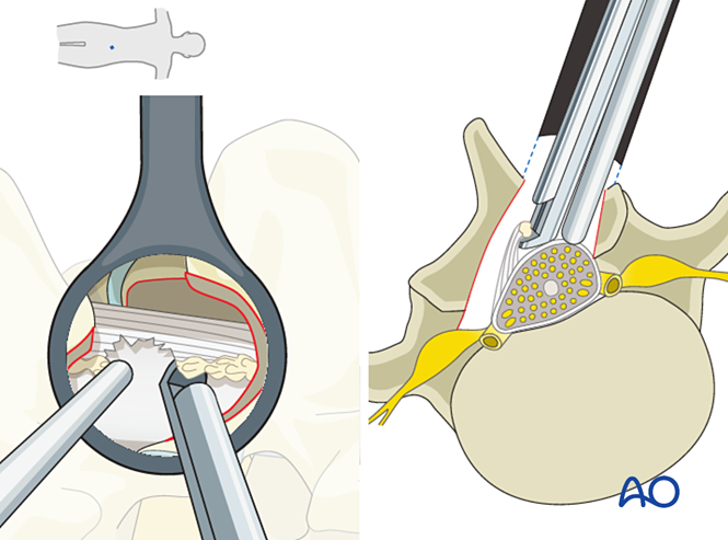 À gauche&nbsp;: vue à travers le tube pendant que de fines pinces retirent l'os et le ligament épaissi. À droite&nbsp;: coupe où le tube est incliné obliquement au-dessus de la ligne médiane pour libérer aussi le côté opposé.