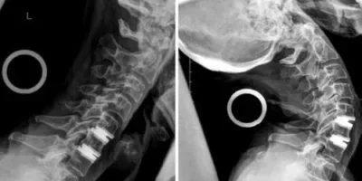 Two side-view X-rays of the neck, bent forwards and backwards, with a disc prosthesis that moves along.