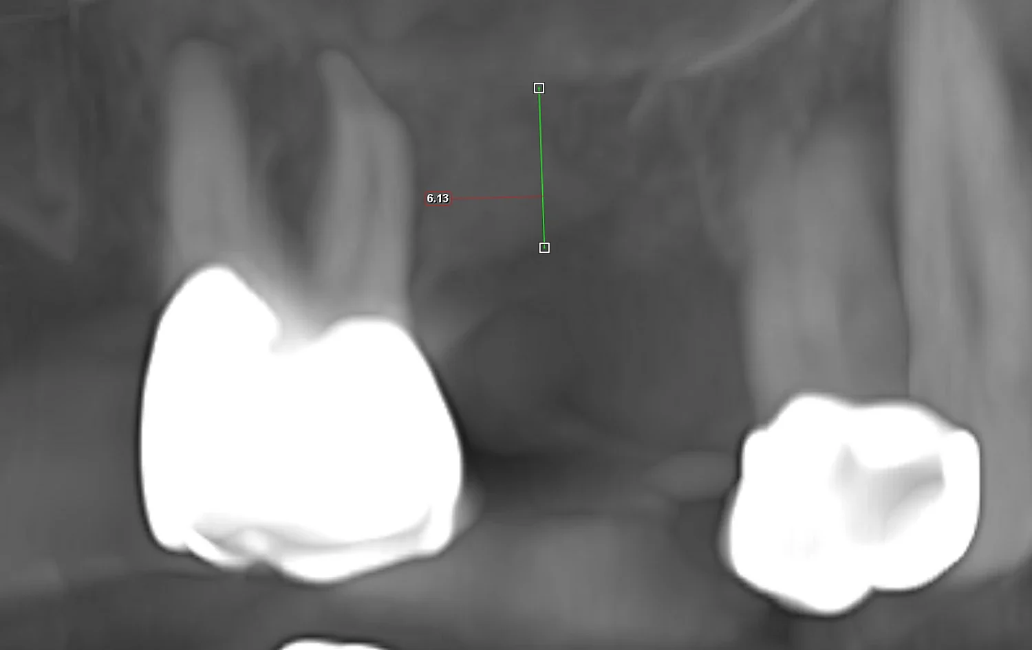 CBCT cross-sectional slice measuring 6mm of residual bone height from the crest of the ridge to the maxillary sinus floor at the tooth #3 implant site — Teuscher Legacy Dental, St. Charles IL