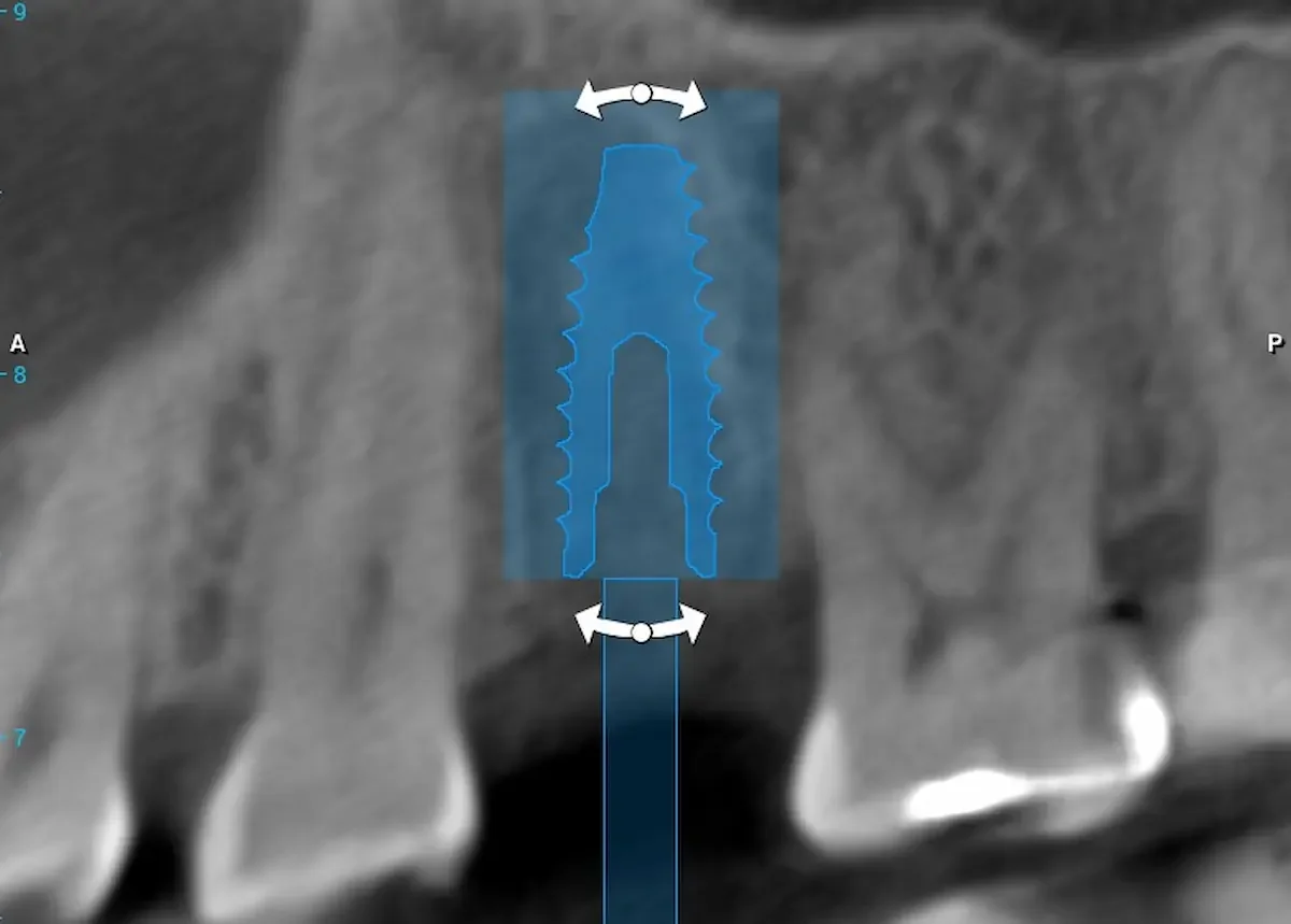 CBCT digital implant planning software screenshot at Teuscher Legacy Dental