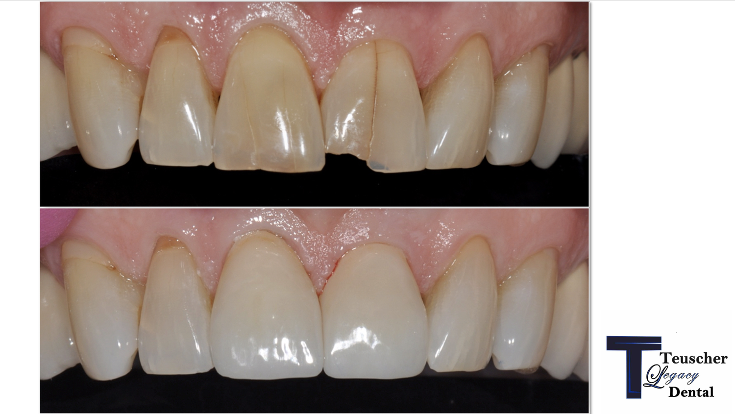 Before and after: Ann's broken front tooth restored with porcelain crowns after whitening at Teuscher Legacy Dental