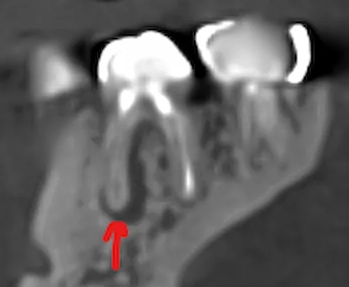 CBCT cross-section from Teuscher Legacy Dental showing a periapical radiolucency — an area of bone change at a tooth root tip — that was difficult to identify on a standard 2D dental X-ray