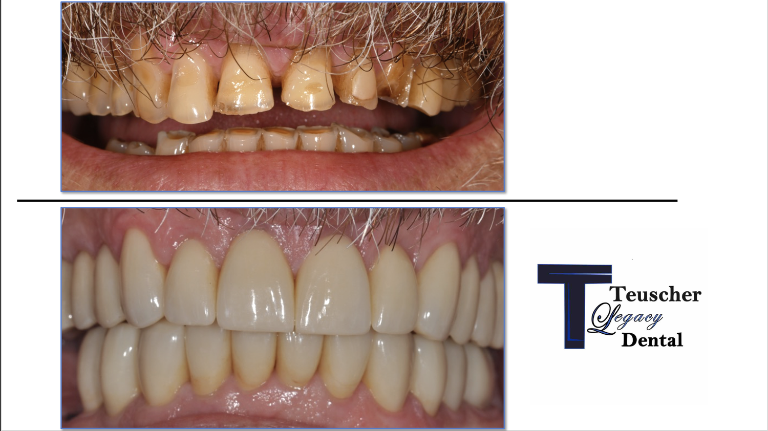 Before and after: Tim's worn teeth rebuilt with a full-mouth crown rehabilitation at Teuscher Legacy Dental