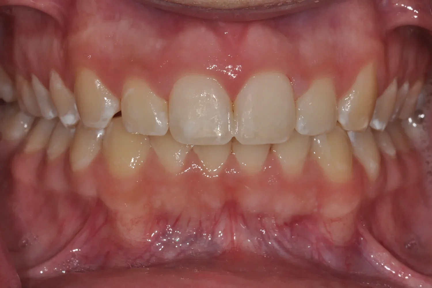Immediately after resin infiltration: white spots on the central incisors blended into surrounding enamel
