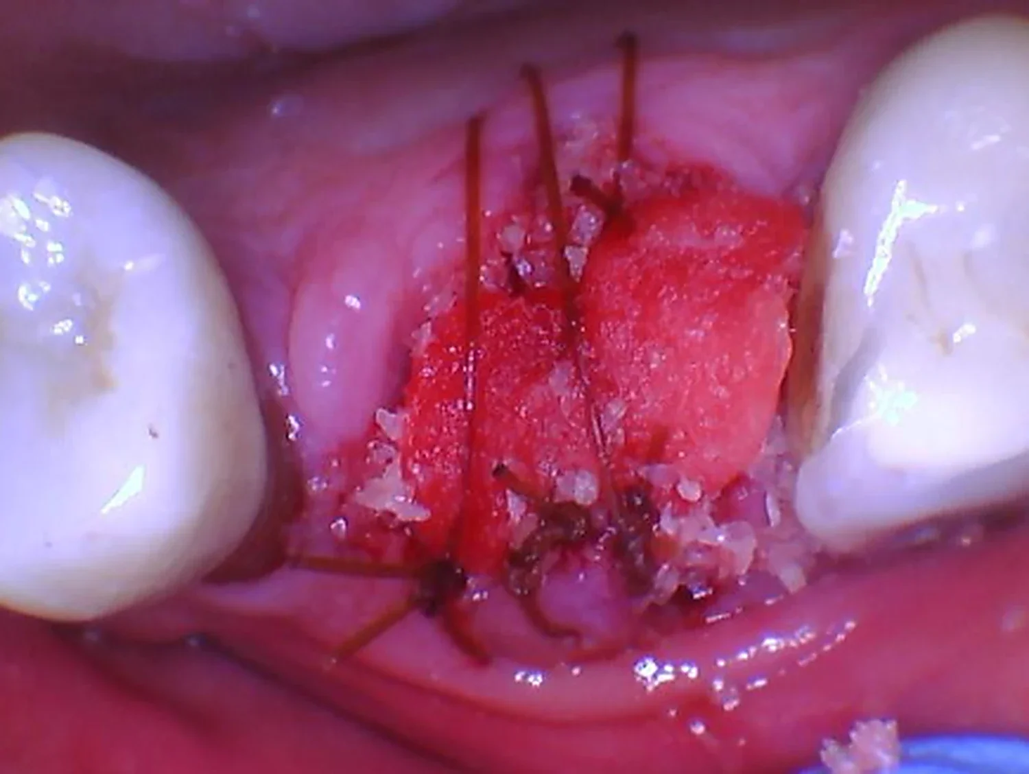 Extraction socket of tooth #3 filled with bone graft and covered by a white collagen plug with sutures, ridge preservation procedure — Teuscher Legacy Dental, St. Charles IL