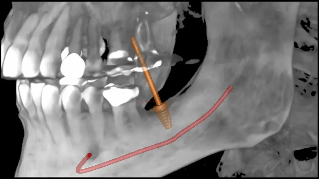 3D CBCT digital implant planning with nerve mapping at Teuscher Legacy Dental, St. Charles IL