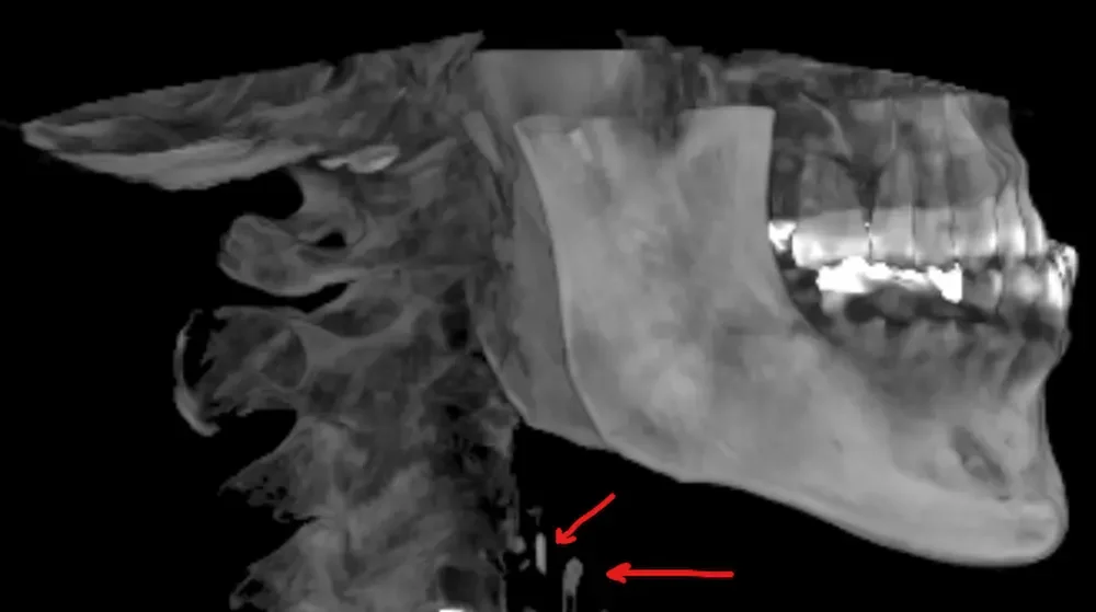 A second de-identified CBCT example from Teuscher Legacy Dental showing a possible carotid artery calcification finding in a different patient