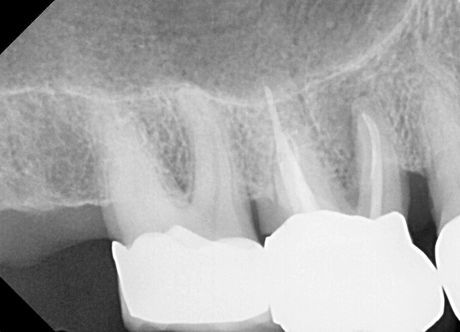 Dental X-ray of tooth #3 showing a failed root canal with periapical infection at the root tips, upper right first molar — Teuscher Legacy Dental, St. Charles IL