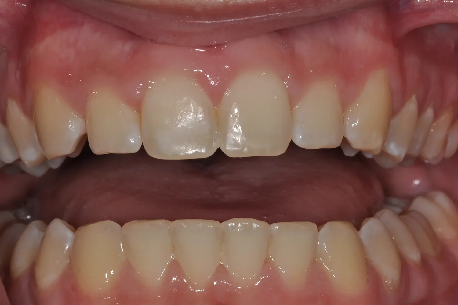 Six days after resin infiltration treatment — the front teeth have rehydrated and the result looks completely natural