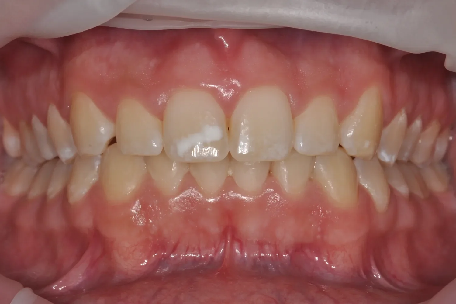Before resin infiltration: chalky white spot lesions on the upper front teeth after orthodontic braces removal