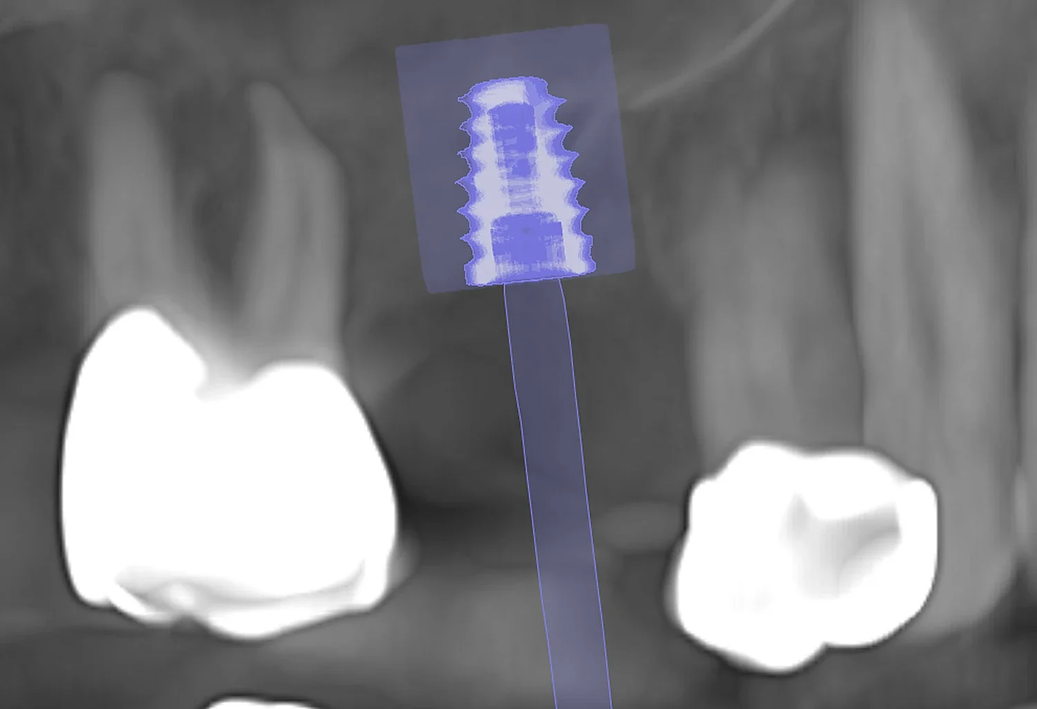 CBCT 3D implant planning software view of the tooth #3 site showing the planned implant extending beyond available bone height into the maxillary sinus, confirming the need for an internal sinus lift — Teuscher Legacy Dental, St. Charles IL