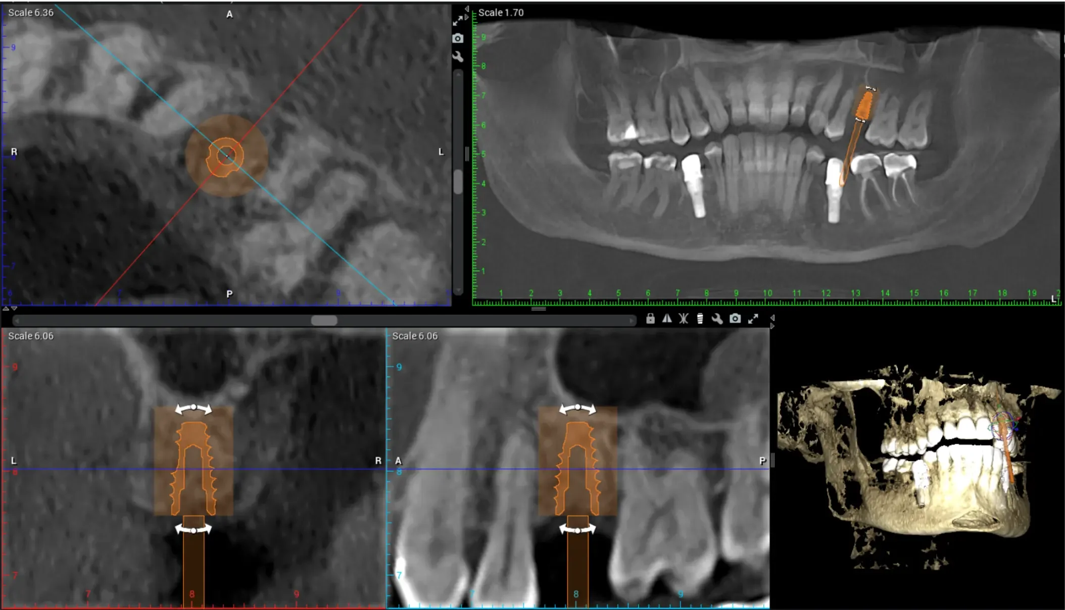CBCT digital planning for socket preservation and dental implants at Teuscher Legacy Dental
