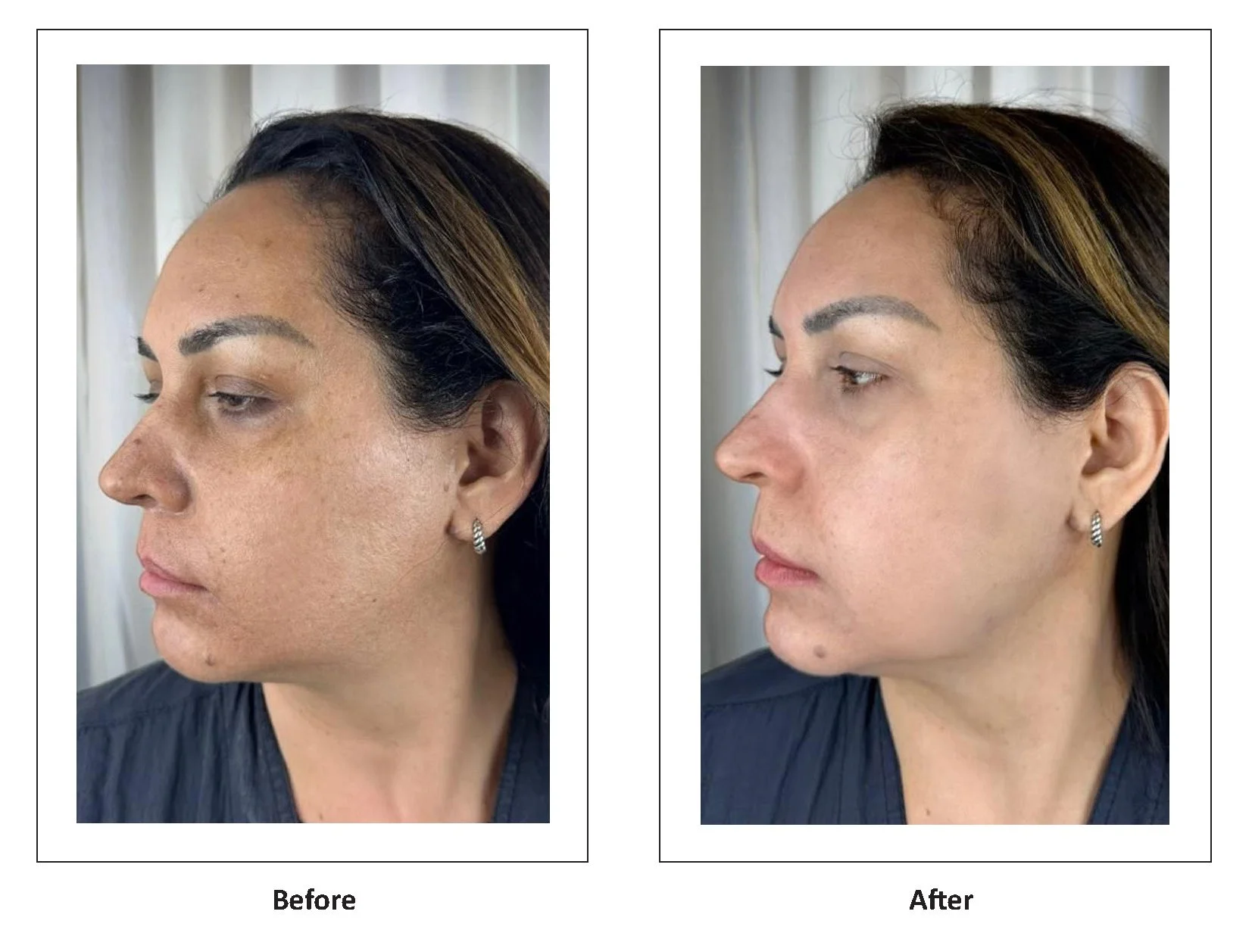 LumiMax CO2 discoloration treatment result