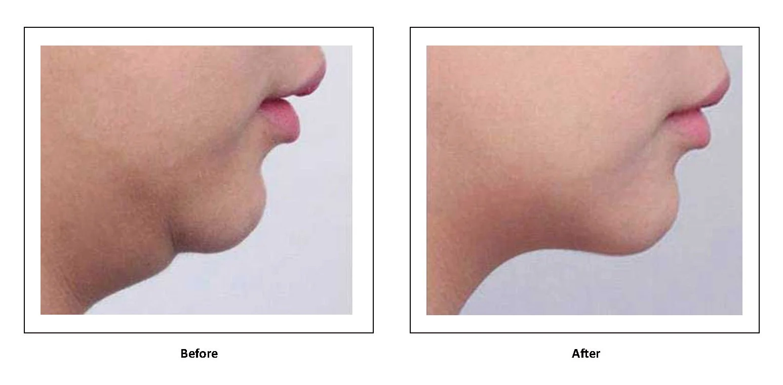 DermaMax RF clinical case — skin tightening, three sessions