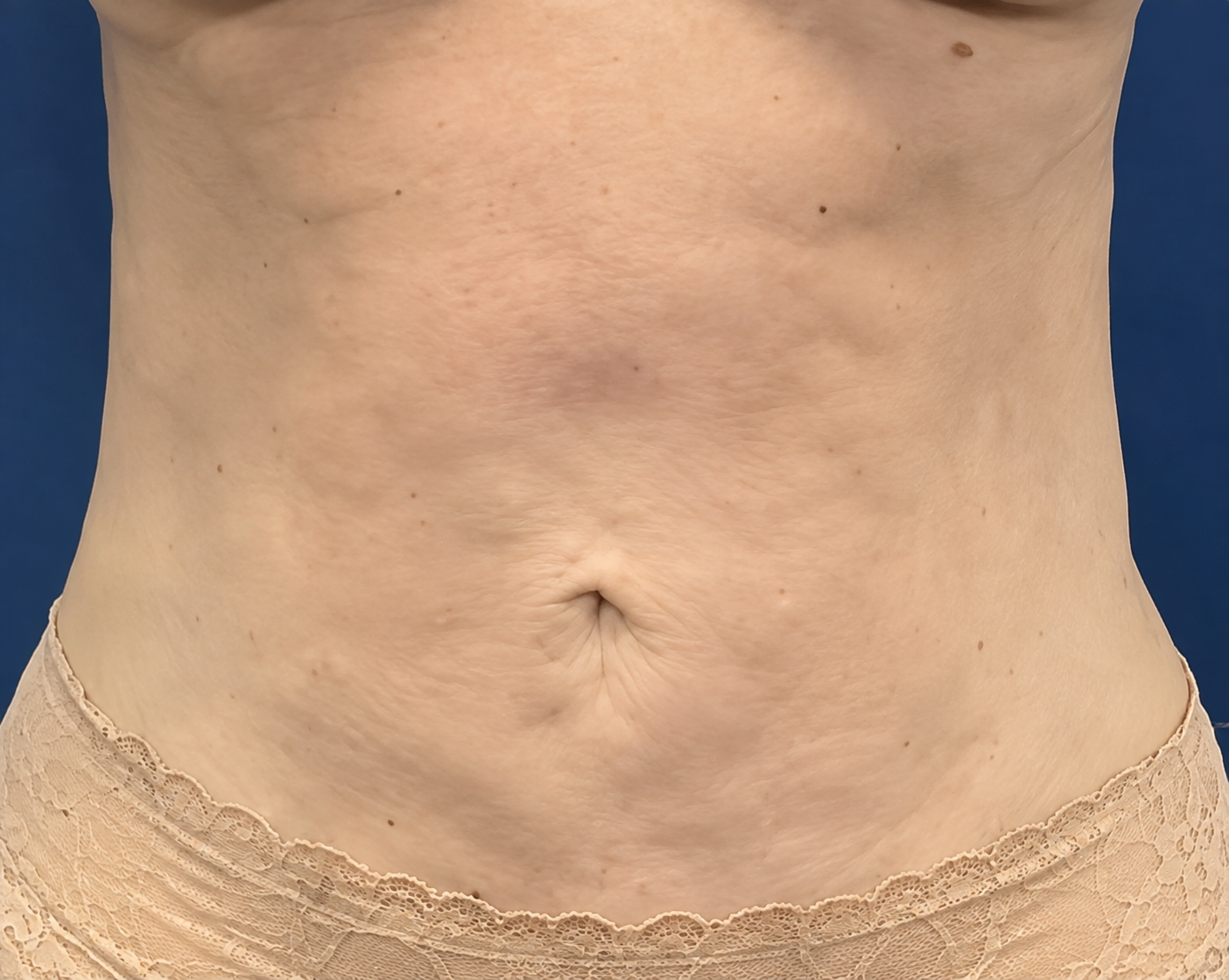 After LipoMax treatment