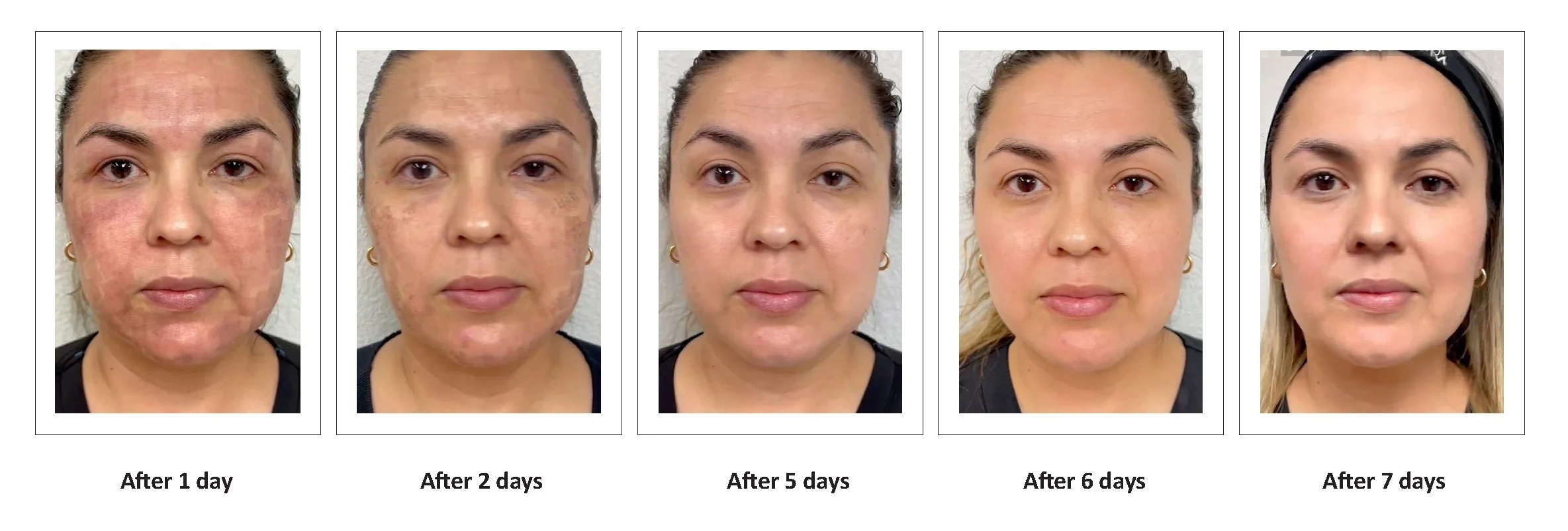 LumiMax CO2 rejuvenation result, view 2