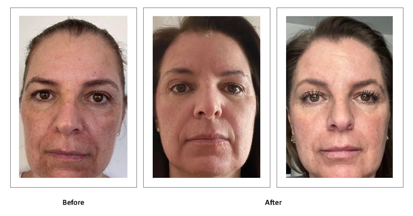 LumiMax CO2 fine lines and wrinkles result