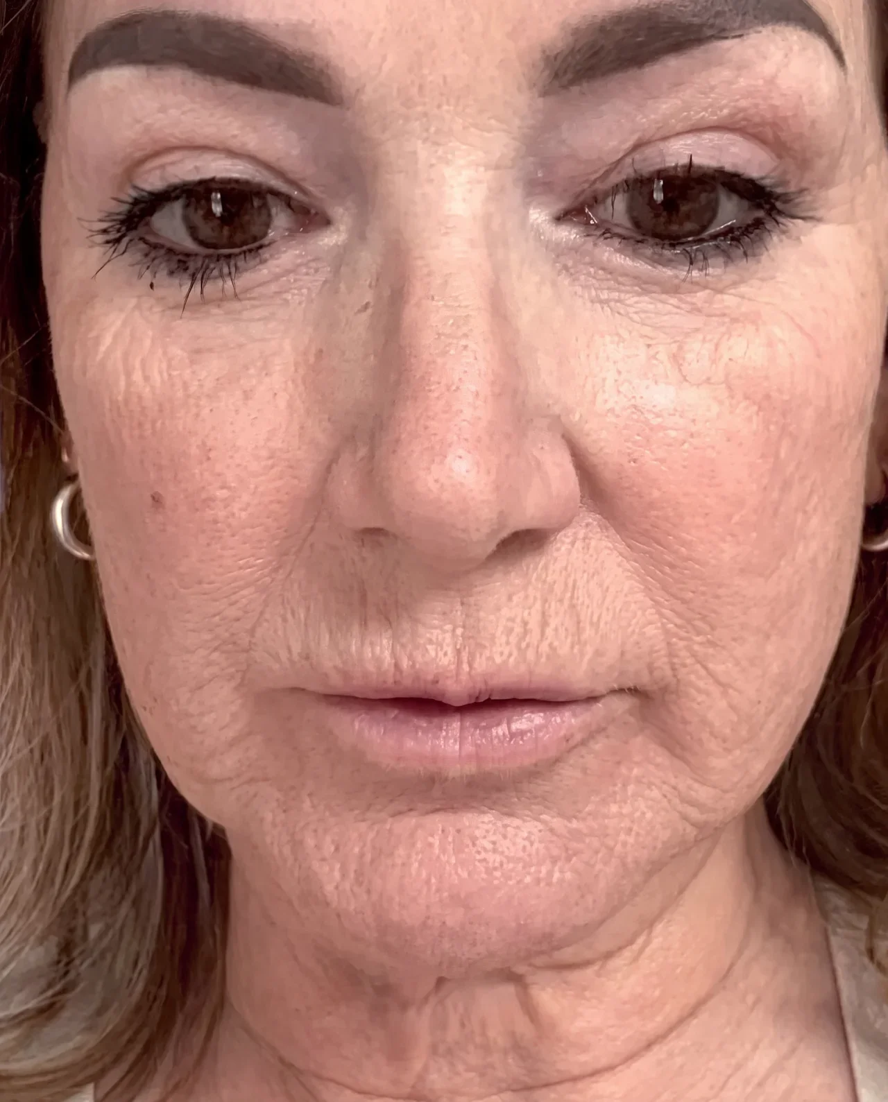 After LumiMax CO2 treatment for fine lines and wrinkles