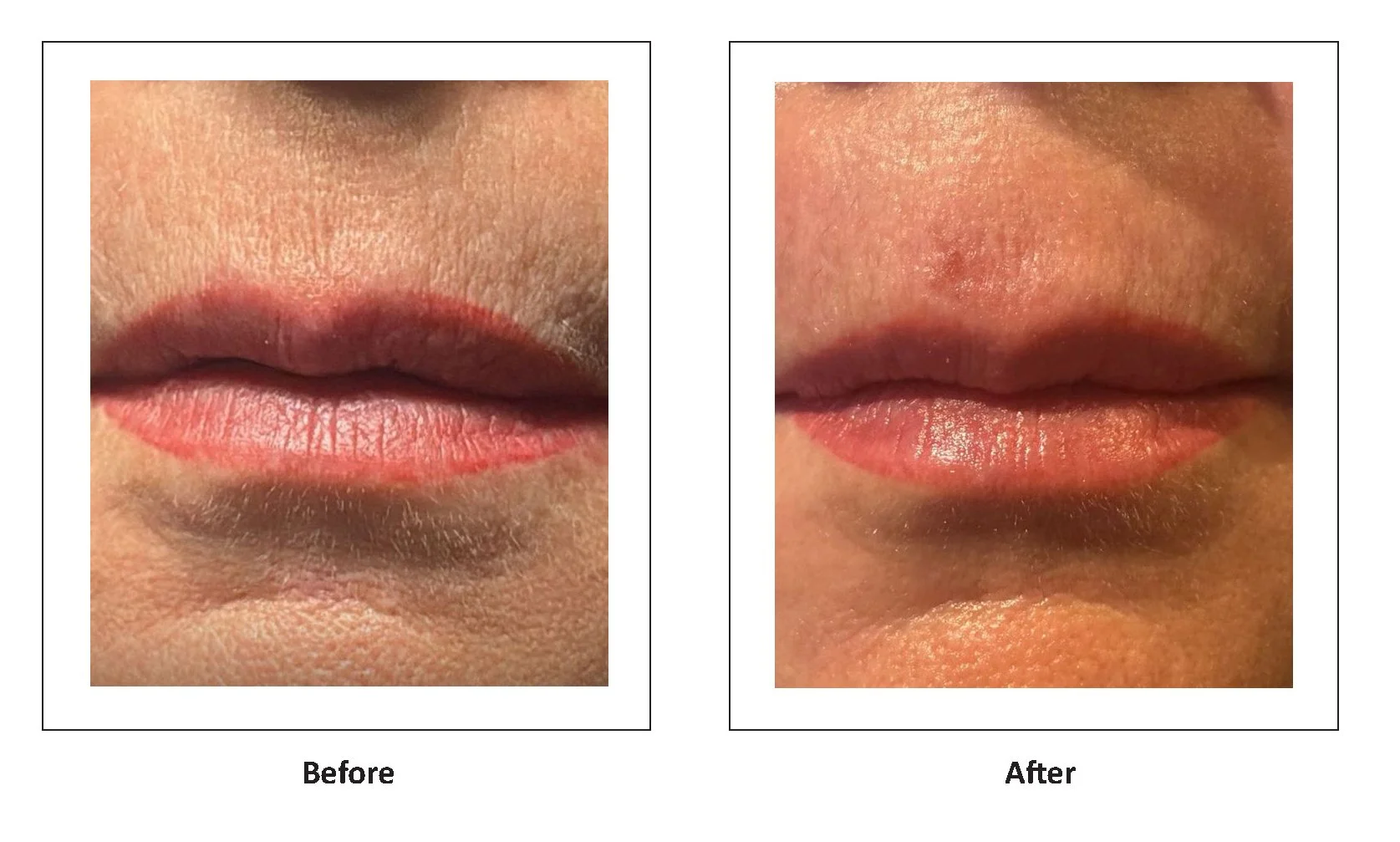 LumiMax CO2 fine lines and wrinkles result