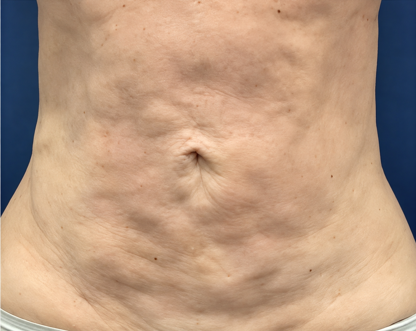 Before LipoMax treatment