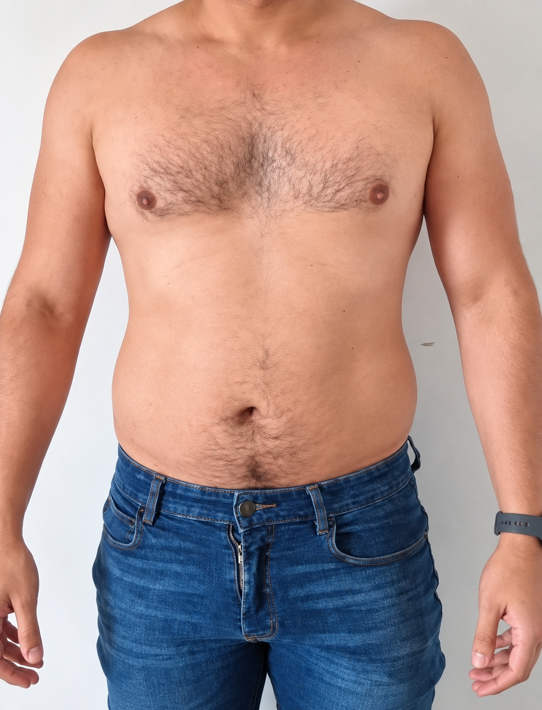 Before LipoMax treatment