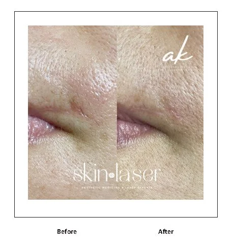 LumiMax CO2 scar reduction result